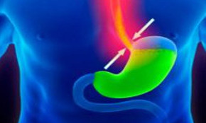 Los síntomas del reflujo gastro-esofágico derivados de la hernia de hiato tienen solución con cirugía mínimamente invasiva